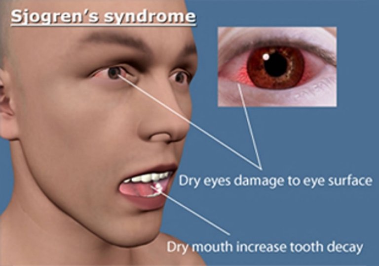 Sjogrens Syndrome Integrated Specialist Medical Care